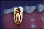 Root Canal2