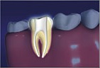 Root Canal3
