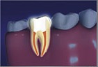 Root Canal4
